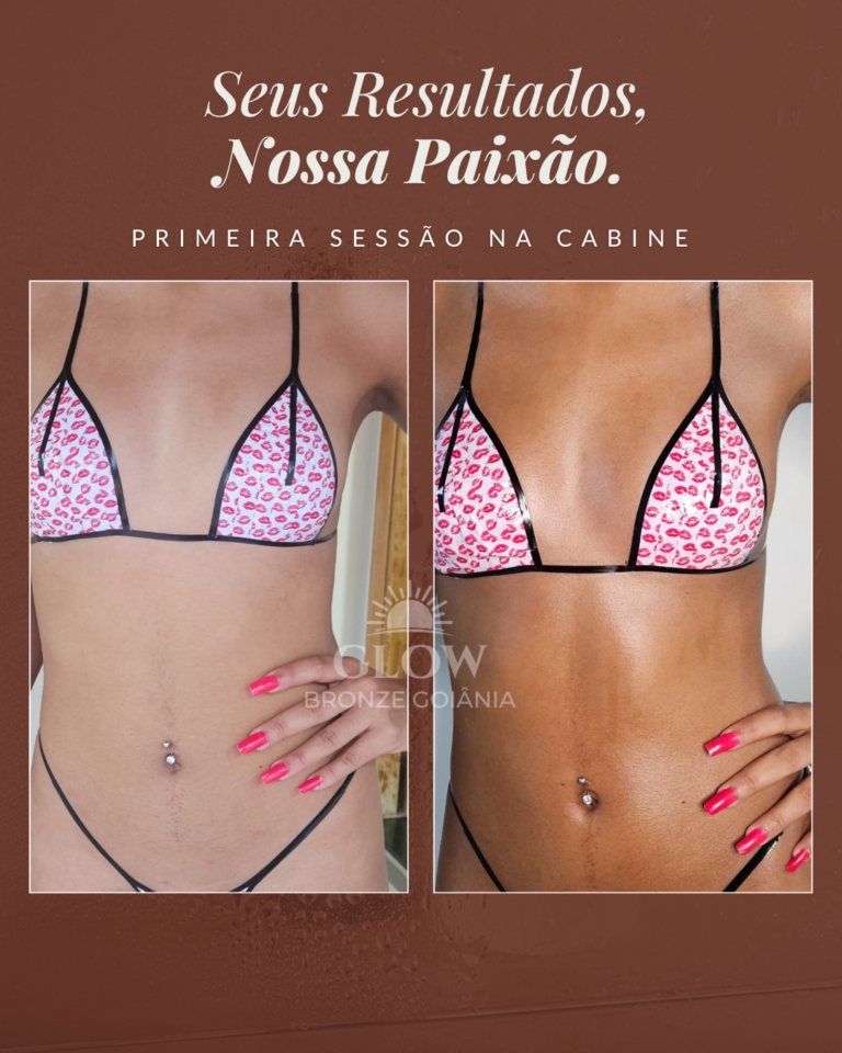 Antes e depois de bronze perto de mim em Goiânia mostrando resultado natural e marquinha uniforme